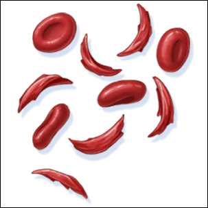 a medical illustration of sickle cell anemia