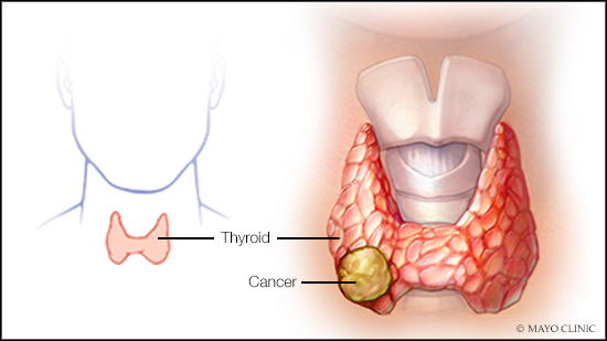 Ilustración médica del cáncer de tiroides