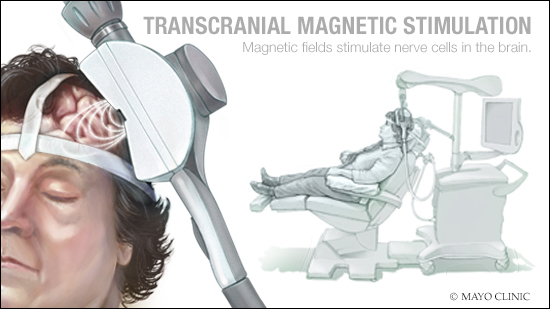 Ilustración médica de la estimulación magnética transcraneal