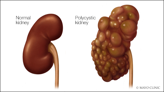medical illustration of a normal kidney and a polycystic kidney