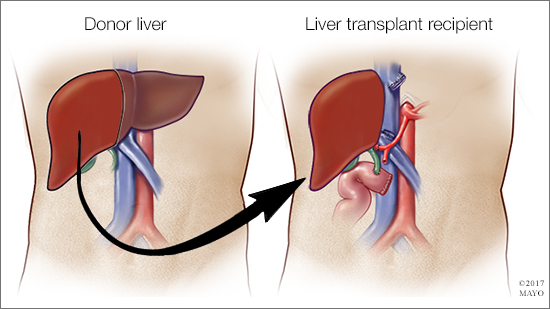 Ilustración médica de un trasplante hepático