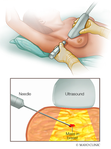a medical illustration of a needle biopsy for breast cancer