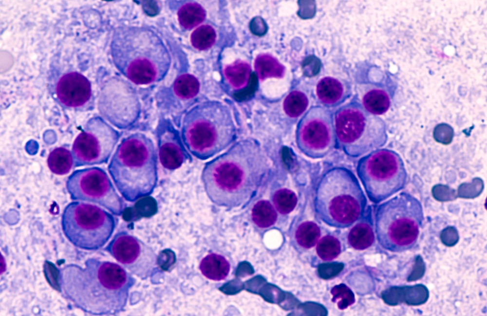 Bone marrow aspirate cytology of multiple myeloma