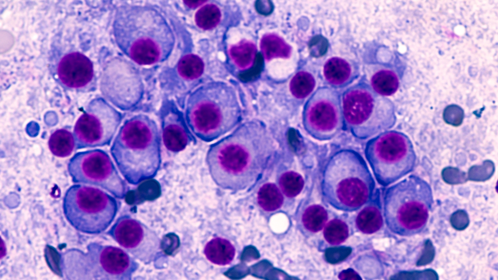 Bone marrow aspirate cytology of multiple myeloma