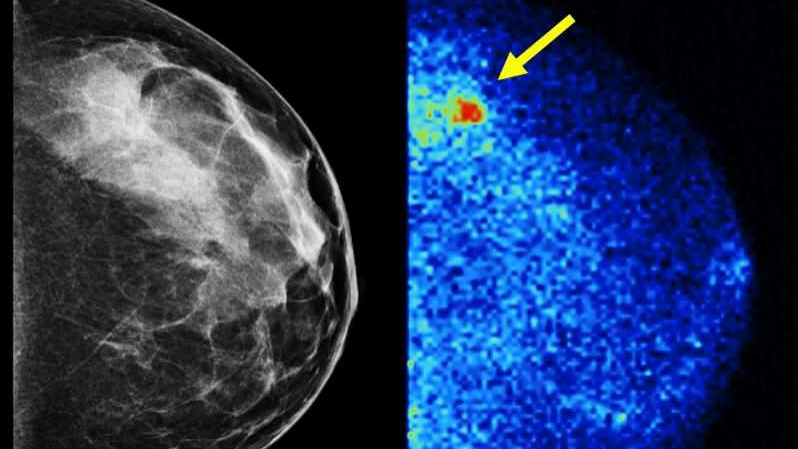 Molecular Breast Imaging (right) detected 3.6 times as many invasive cancers as digital mammography (left)