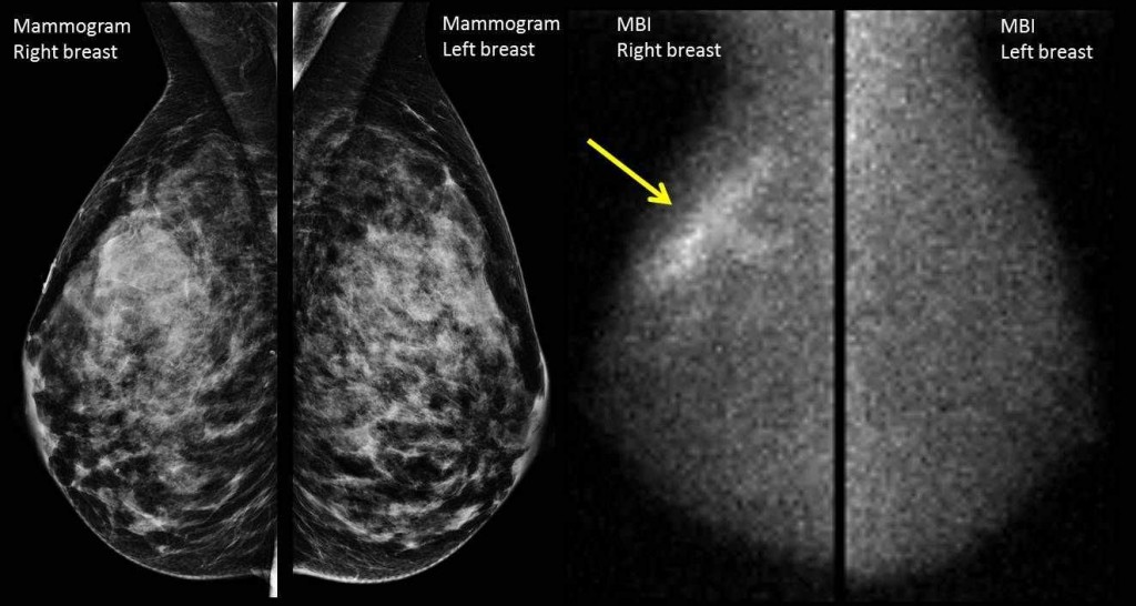 a medical illustration of the difference in appearance between a mammogram image and that of molecular breast imaging (MBI)