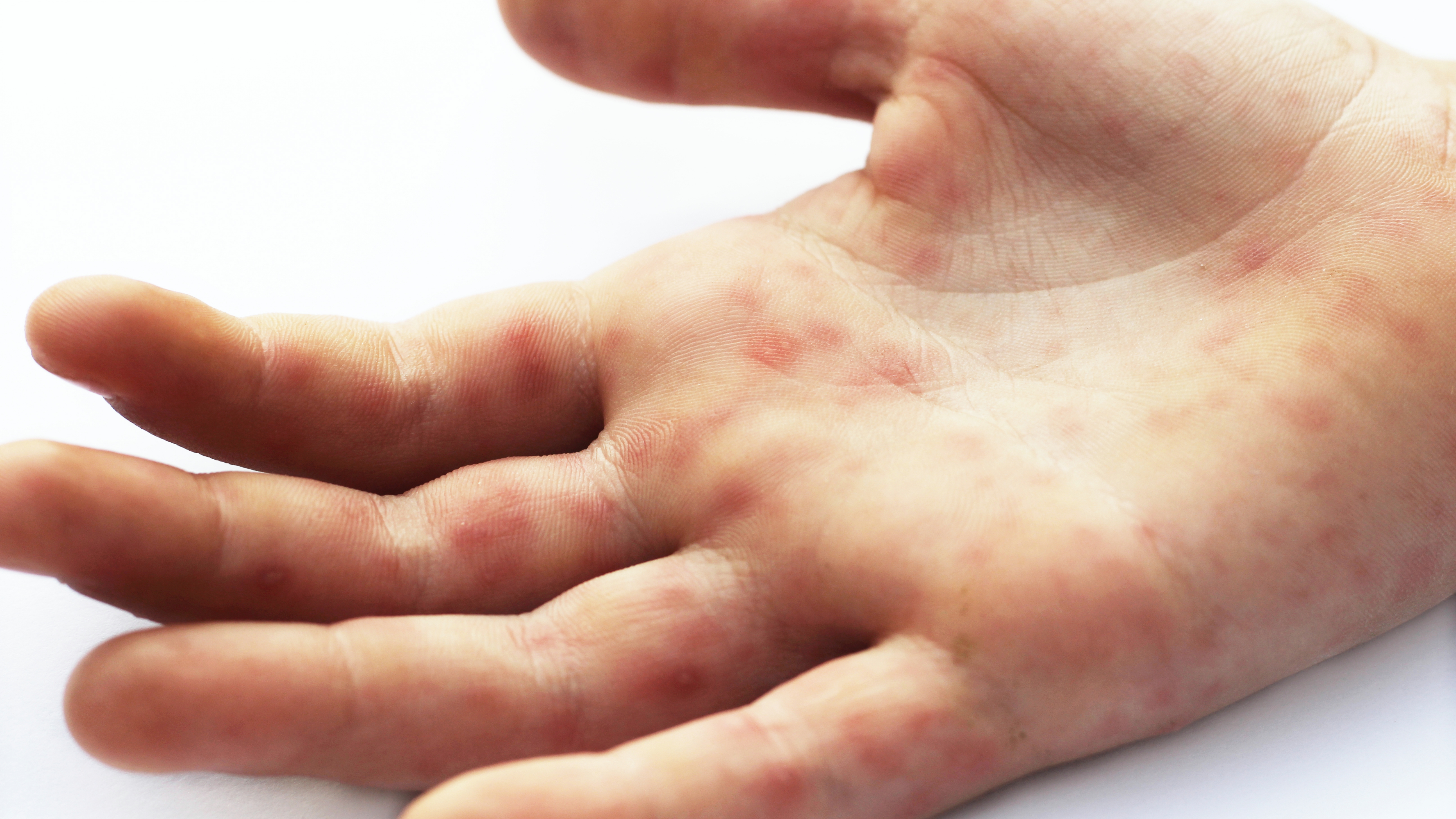 Hand foot and mouth disease with red rash on the palm of the hand. Enterovirus. Coxsackie virus.