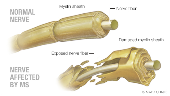 a medical illustration of a normal nerve and one affected by MS