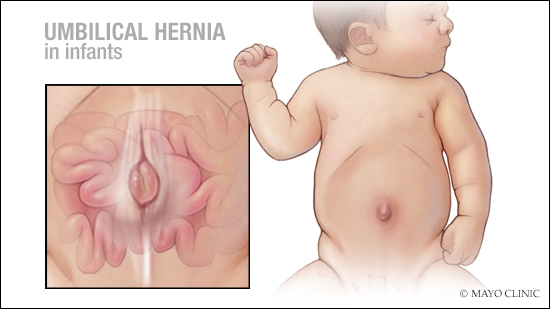 Ilustración médica de la hernia umbilical en un recién nacido