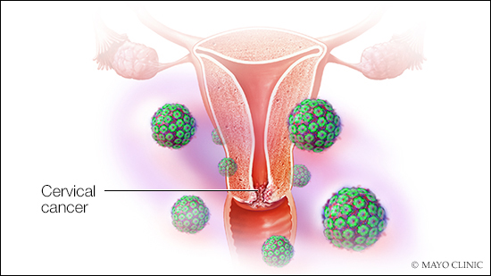 Ilustración médica del cáncer del cuello del útero