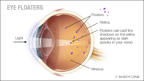 a medical illustration of eye floaters