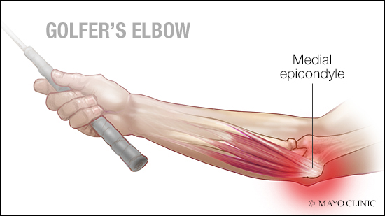 a medical illustration of medial epicondylitis, also known as golfer's elbow