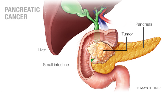 a medical illustration of pancreatic cancer