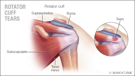 a medical illustration of rotator cuff tears