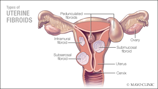 Ilustración médica del sistema reproductivo femenino donde resaltan los diferentes tipos de fibromas uterinos