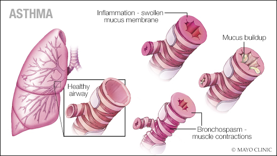 a medical illustration of the effects of asthma with inflammation and mucus