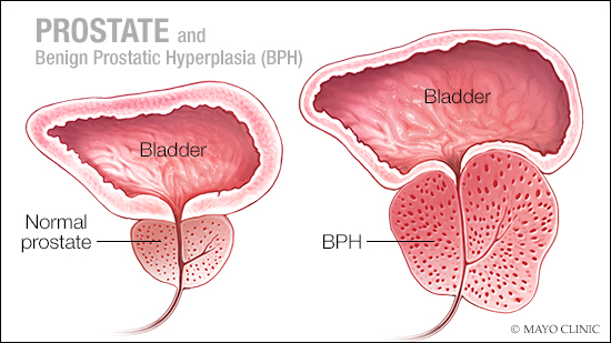 a medical illustration of a normal prostate and one with benign prostatic hyperplasia (BPH)