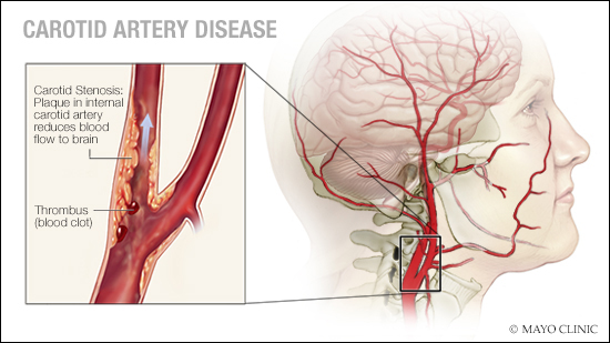 Ilustración médica de la arteriopatía carotídea