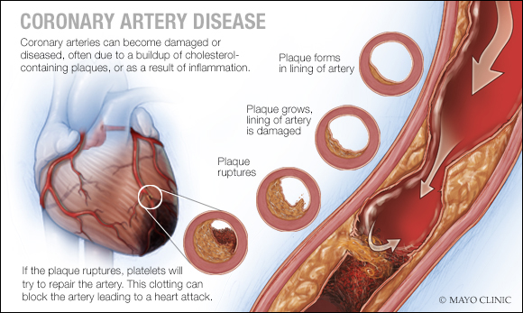 Ilustración médica de la arteriopatía coronaria