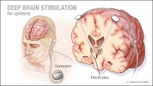 Mayo Clinic Q and A: Deep brain stimulation may reduce seizures caused ...