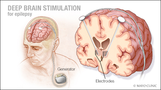 a medical illustration of deep brain stimulation for epilepsy