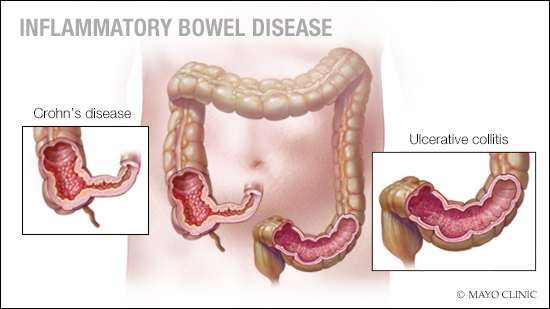 Ilustración médica de la enfermedad inflamatoria intestinal