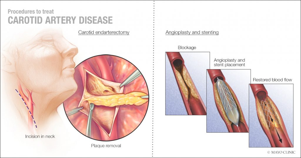 Ilustración médica de los procedimientos para tratar la arteriopatía carotídea, entre ellas la endarterectomía carotídea y la angioplastia con colocación de estent 