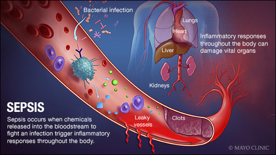 Ilustración médica de la sepsis