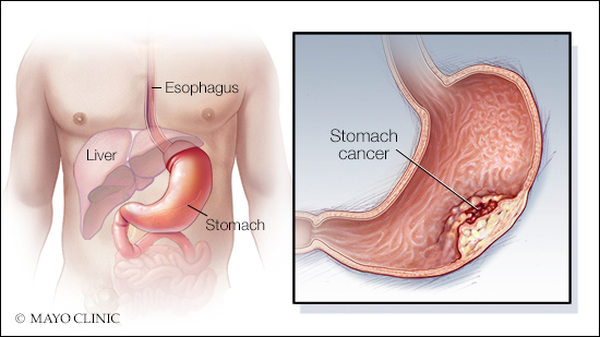 a medical illustration of stomach cancer