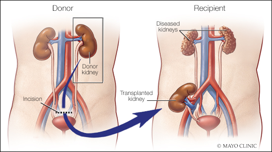 Medical illustration of living kidney donation