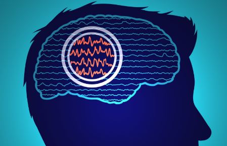 Ilustración médica o gráfico que muestra el cerebro durante una convulsión, como representación de la epilepsia