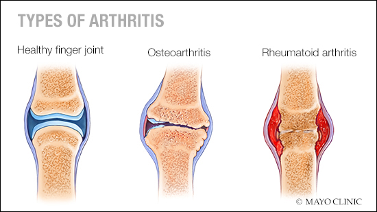 Una ilustración médica de una articulación del dedo sana, una con osteoartritis y otra con artritis reumatoide.