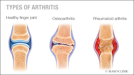 Rheumatoid Arthritis Disease Progression: Signs Rheumatoid