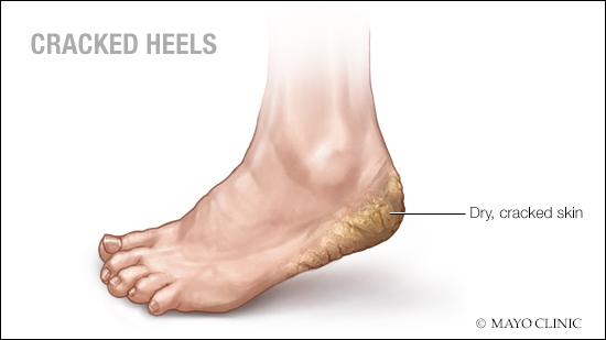 a medical illustration of the dry, cracked skin of cracked heels