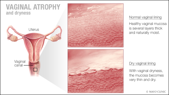 a medical illustration of vaginal atrophy and dryness