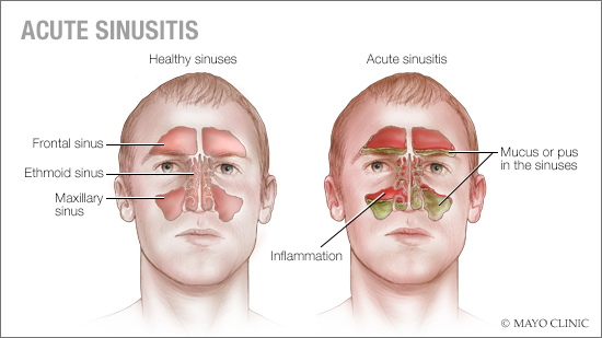 a medical illustration of healthy sinuses and acute sinusitis