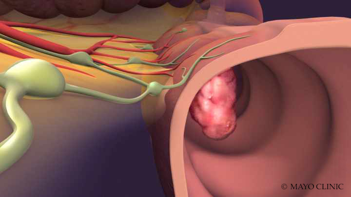 Can colorectal cancer be prevented? - Mayo Clinic News Network