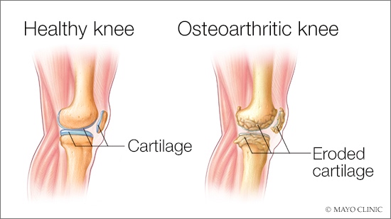 medical illustration of osteoarthritis