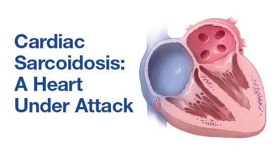 a medical illustration of a heart under attack, cardiac sarcoidosis