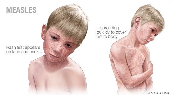 a medical illustration of a young boy with measles