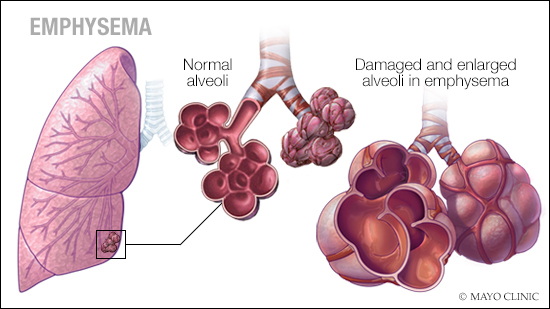 a medical illustration of emphysema