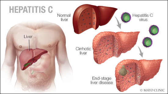 a medical illustration of hepatitis C