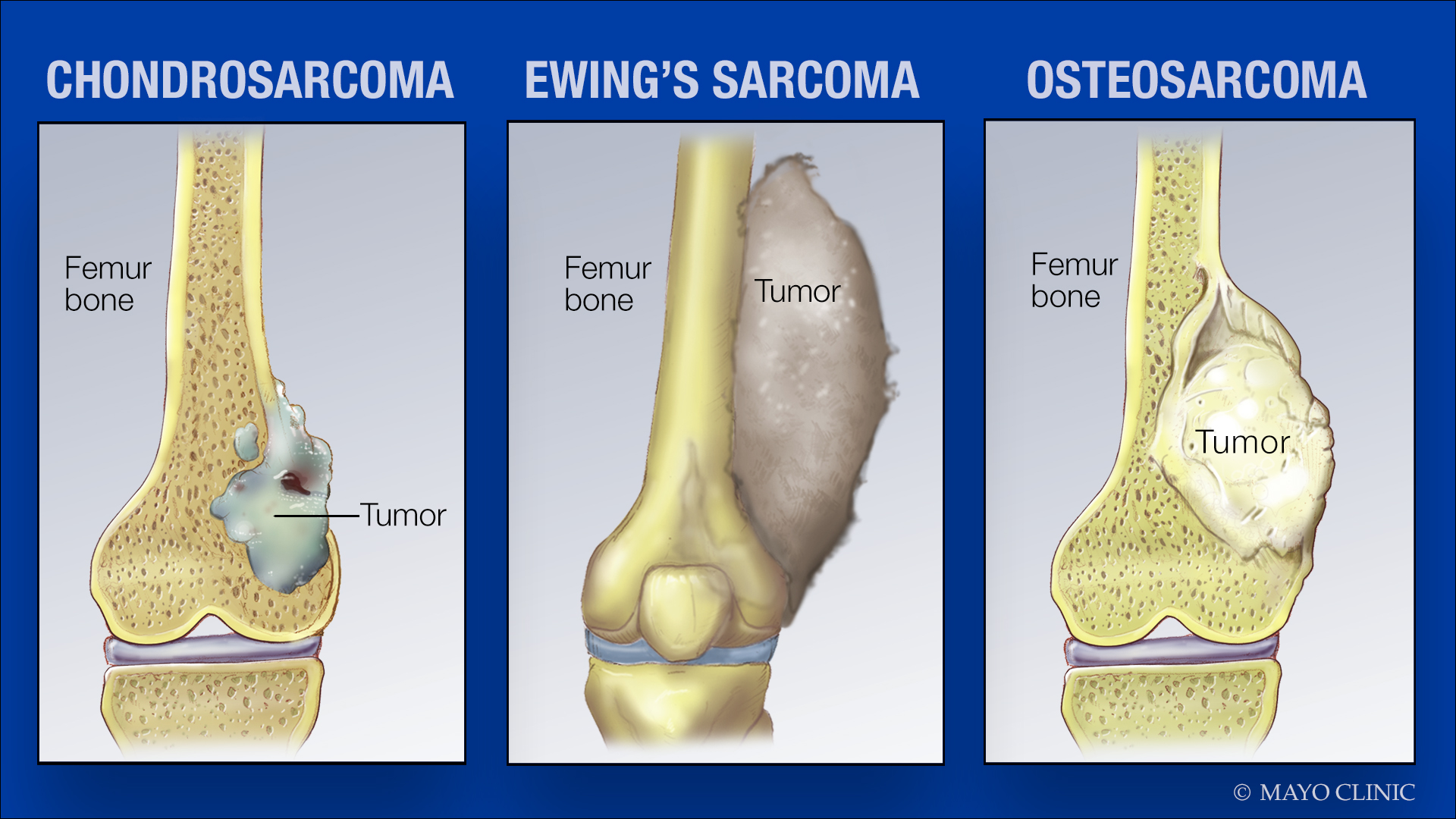 medical illustrations of sarcoma tumors