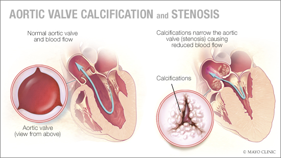 a medical illustration of aortic valve calcification and stenosis