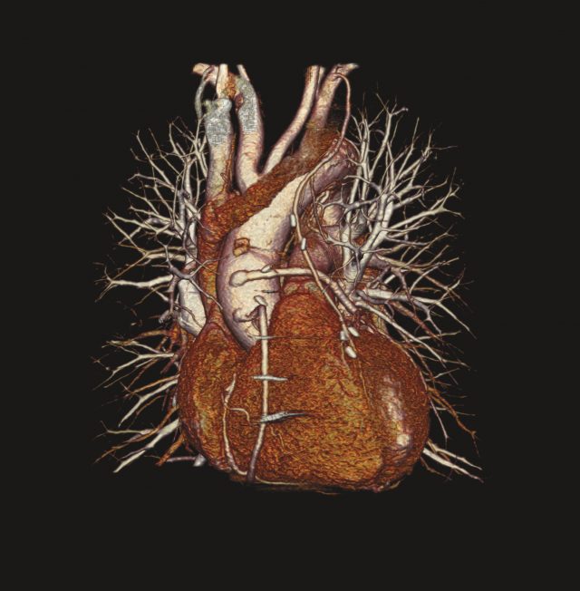 an enhanced CT scan of a heart