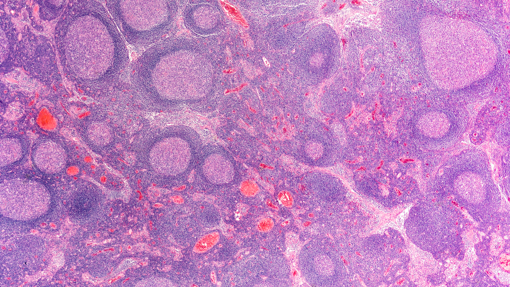 Microscopic image of a lymph node biopsy