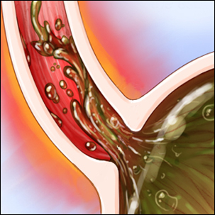 a medical illustration of Barrett's esophagus