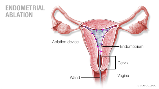 a medical illustration of endometrial ablation