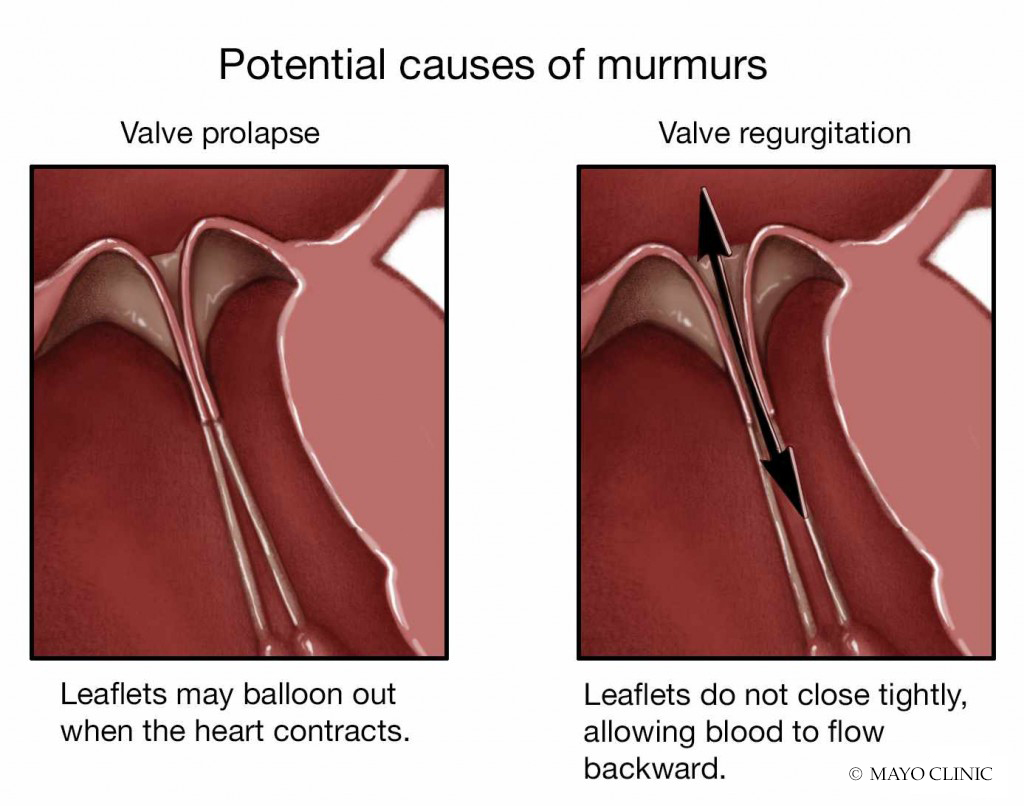 medical illustration for potential causes of murmurs with valve prolapse or valve regurgitation