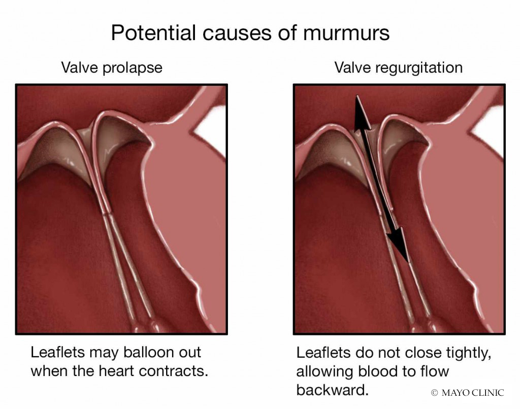 Heart Murmur Mitral Valve